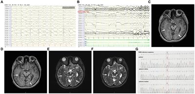 RELN gene-related drug-resistant epilepsy with periventricular nodular heterotopia treated with radiofrequency thermocoagulation: a case report